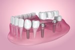 Dental Bridges