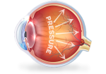 Glaucoma