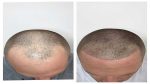 hair regrowth treatment in Vadodara