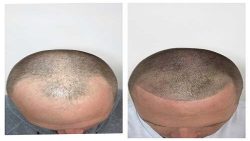 hair regrowth treatment in Vadodara