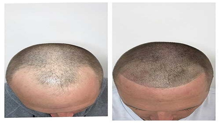 hair regrowth treatment in Vadodara