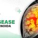 Alcohol Related Liver Disease Treatment In Noida