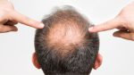 hair bald treatment is hair transplant