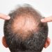 hair bald treatment is hair transplant