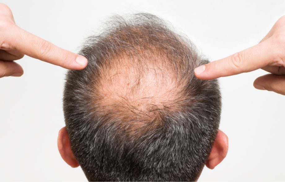 hair bald treatment is hair transplant